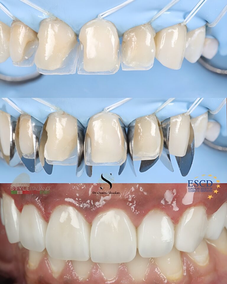 Курс ,,Преобразяване на усмивката с бондинг – опростен подход за предвидим резултат в едно посещение"