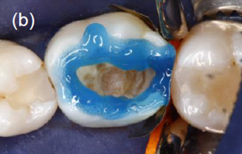 Adhese 2 DC VivaPen Kit 2ml/100