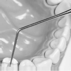 Root Canal Explorer