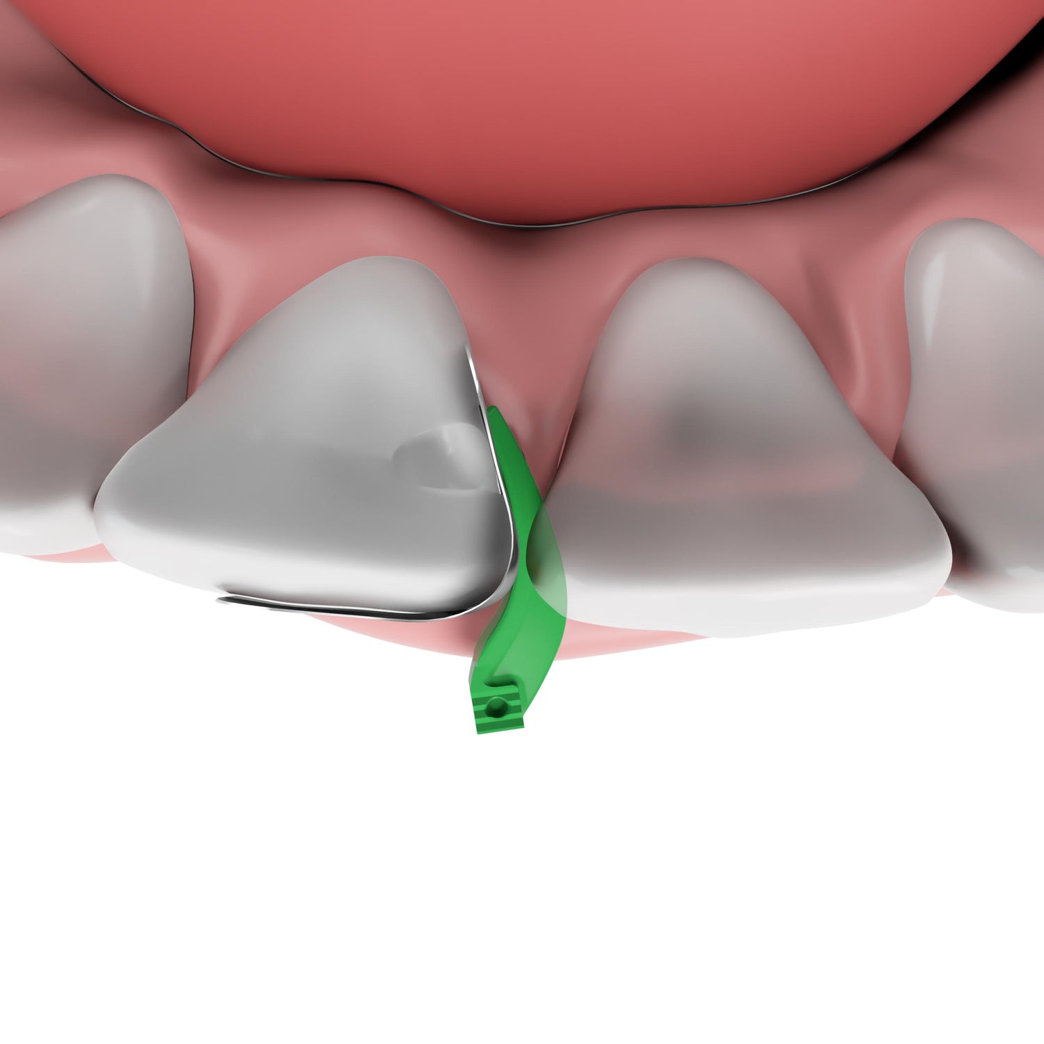 Fusion™ Anterior Matrix System