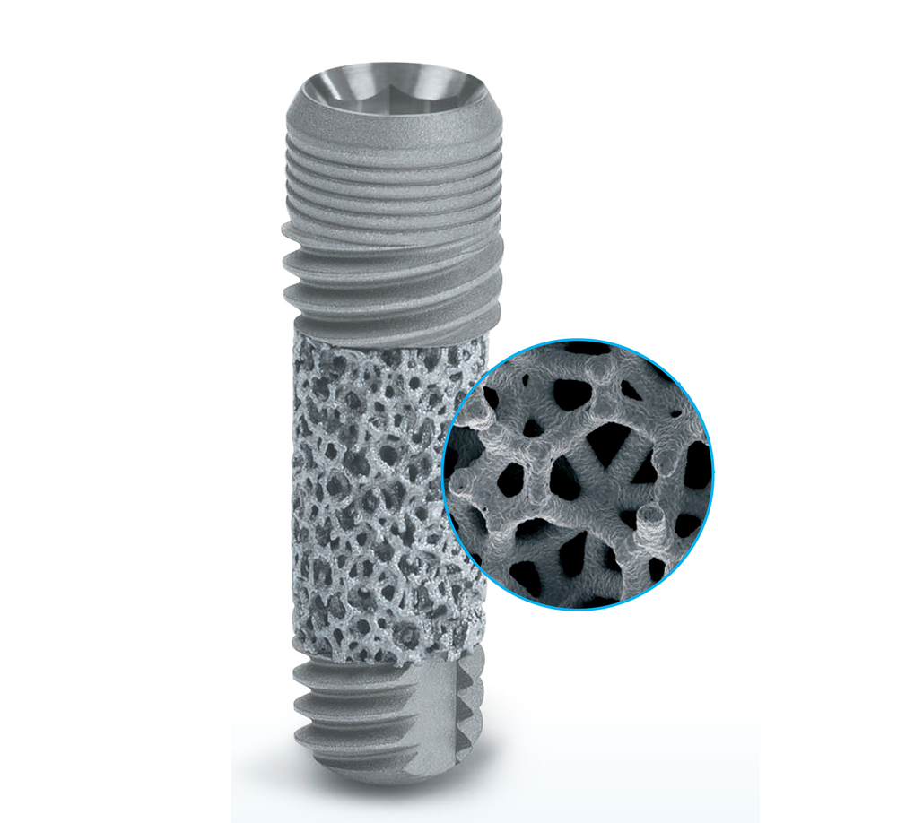 Trabecular metal® dental implants with 0.5mm machined collar