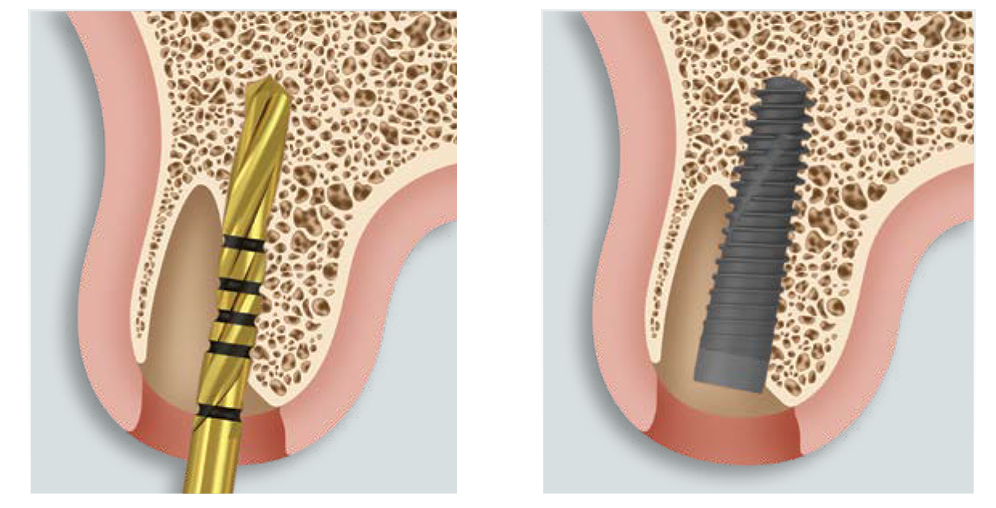 TSX® Implant System