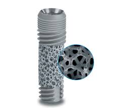 Trabecular Metal® Implants