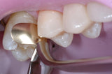 Gold Bicuspid/Molar Matrix Bands