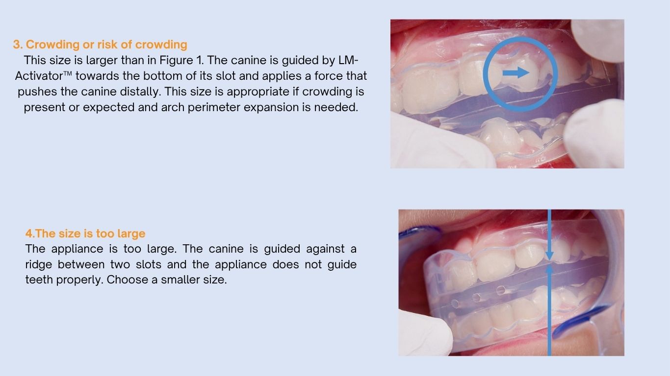 LM-Activator™ OrthoSizer™