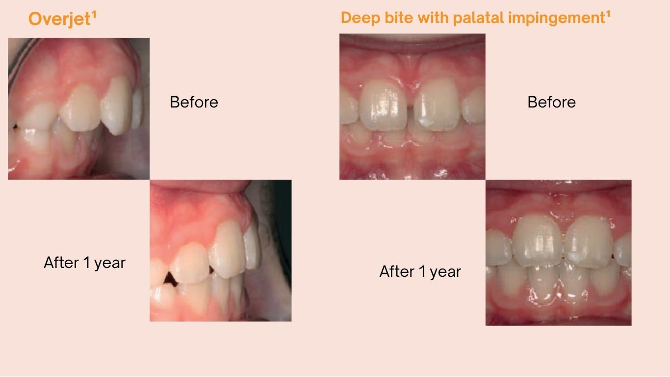 LM-Activator™ Low Short