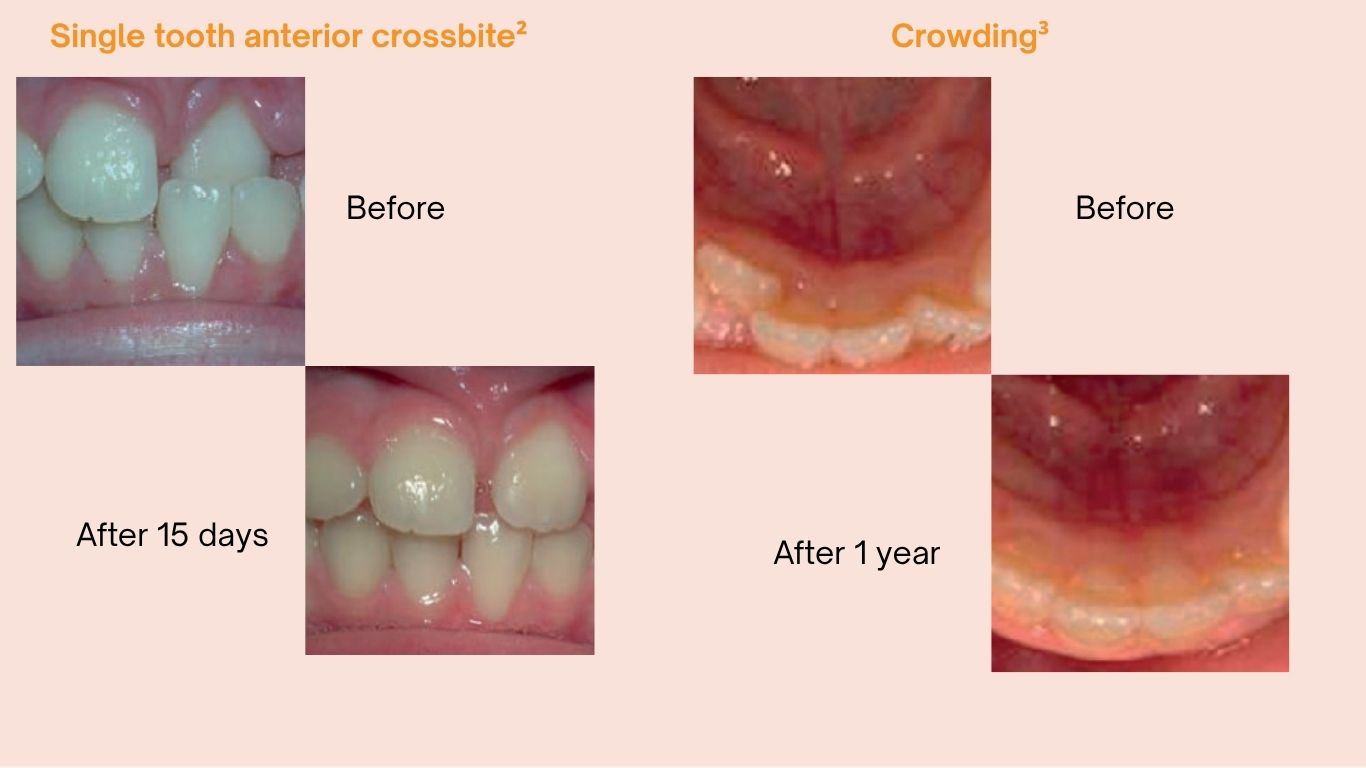 LM-Activator™ Low Short