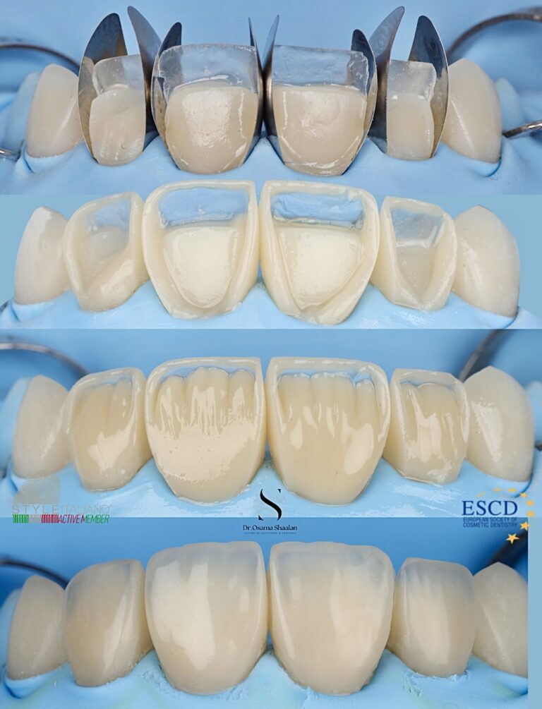 Курс ,,Преобразяване на усмивката с бондинг – опростен подход за предвидим резултат в едно посещение"