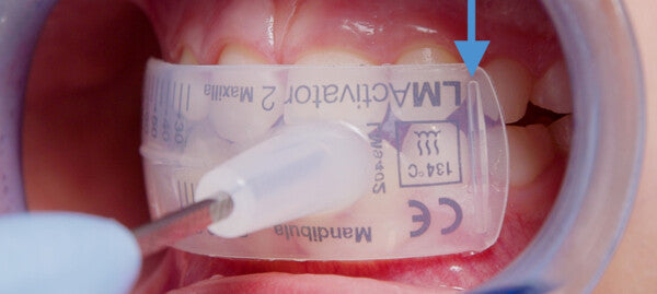LM-Activator™ OrthoSizer™