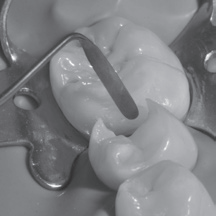 LM-Arte™ Applica Twist
