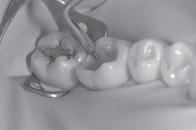 LM-Arte™ Posterior Misura