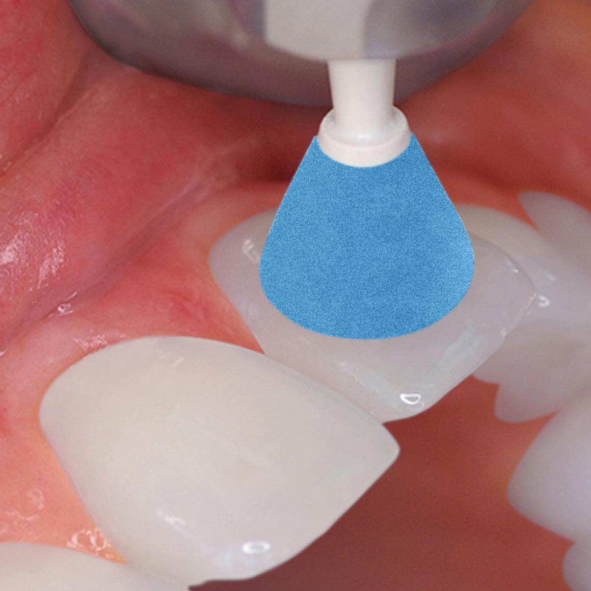 Rally BLUE coarse grit CUP composite polisher
