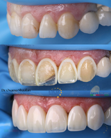 Курс ,,Преобразяване на усмивката с бондинг – опростен подход за предвидим резултат в едно посещение"