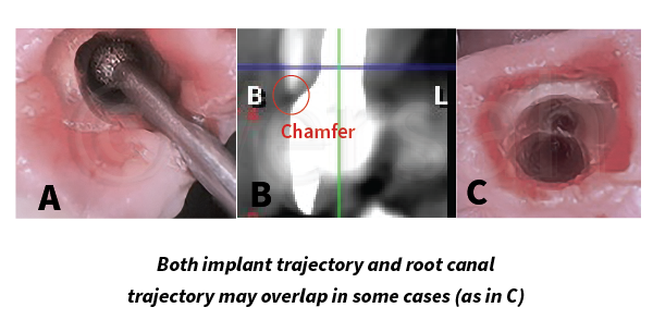 Selective Preservation of Tooth(Protocol)