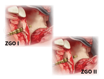 Zygoma Protocol I/II