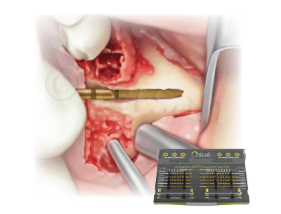 Zygoma Protocol IV