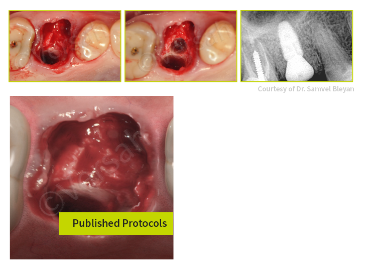 Combied Upper Molar Septum Protocol