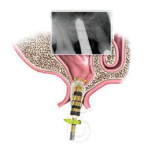 Crestal Sinus Lift II