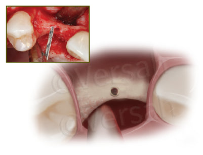 Guided Expansion Graft Protocol