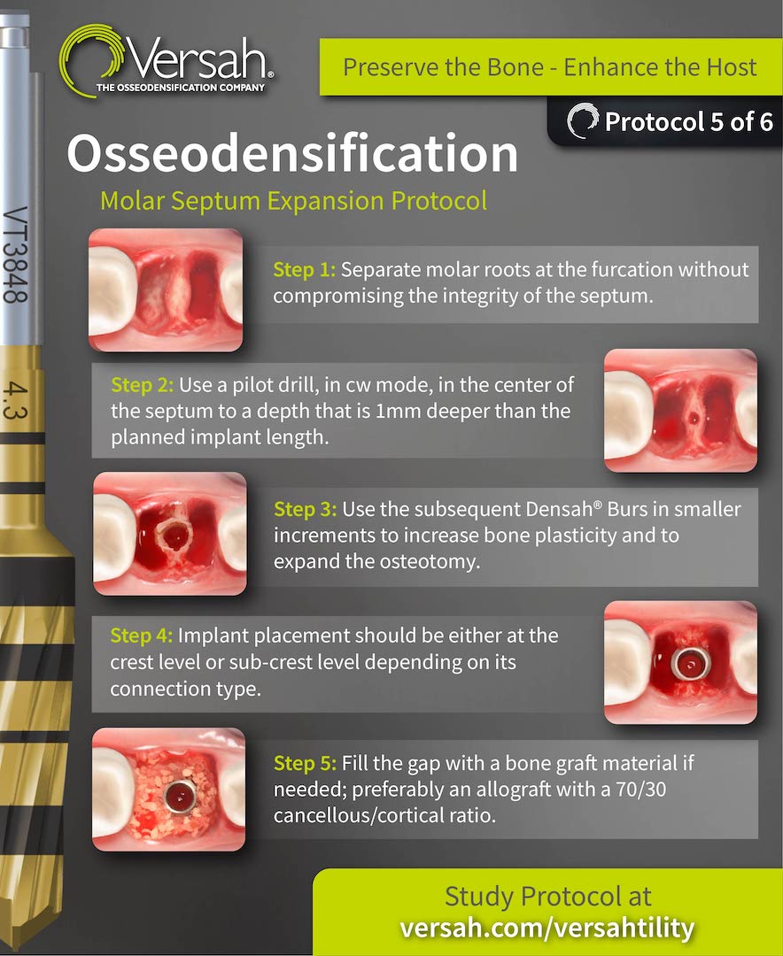 Molar Septum Protocol