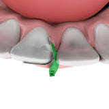 Fusion™ Anterior Matrix System
