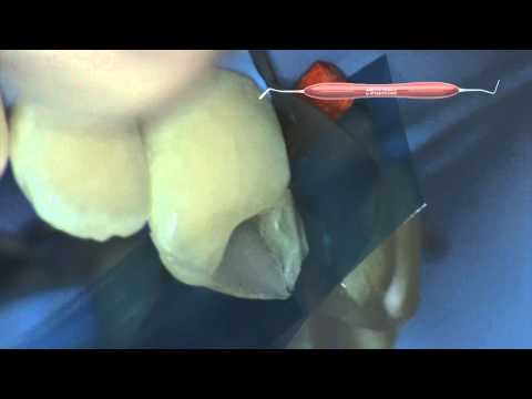 LM-Arte™ Applica Dark Diamond