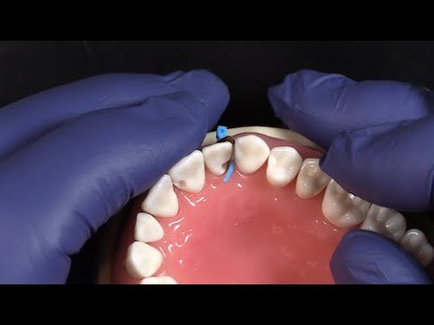 Tall Fusion Anterior Matrix Bands/10.4mm