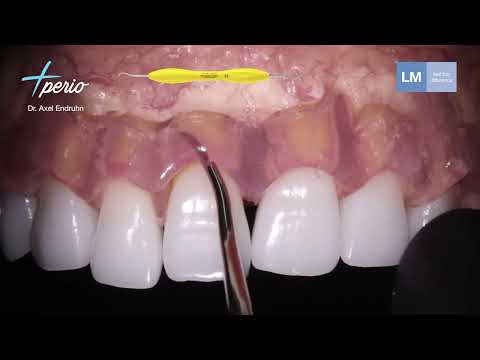 LM™ Papilla Solleva
