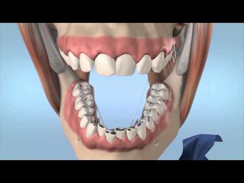 Артикулационно фолио Arti-Fol®, 8 микрона(µ), 75мм