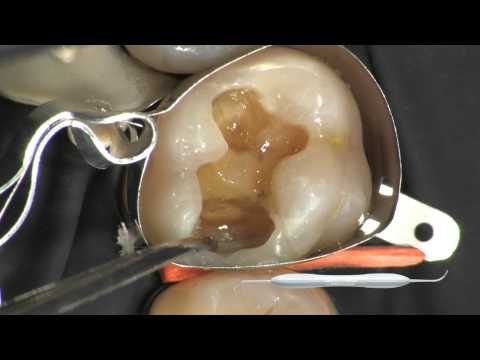 LM-Arte™ Condensa Dark Diamond
