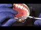 Garrison® Premier Ring Placement Forceps