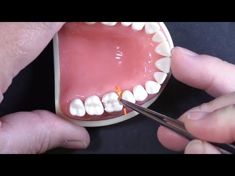 Composi-Tight 3D Fusion Extra Small Yellow Wedge Bulk Refill
