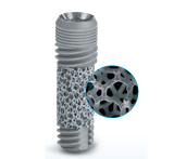 Trabecular metal® dental implants with 0.5mm machined collar