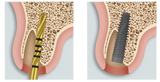 TSX® Implant System